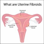 Fibroid Illustration
